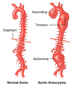 aortic_aneurysm